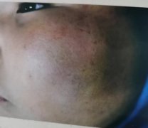 村民诉称其儿子被村干部带人殴打致创伤